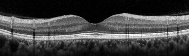 망막 두께를 정밀 분석하는 '빛간섭단층촬영' 영상