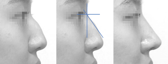 콧대가 높은 매부리코의 원인도 대개 낮은 코끝이다. 콧등을 줄이면서, 코끝을 높여 준다.