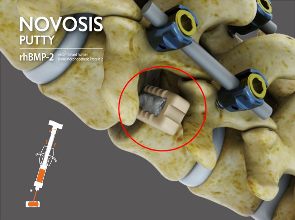 척추 유합술에 시지바이오 골대체재 '노보시스-퍼티'를 적용한 모습. /사진=시지바이오