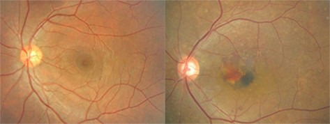 정상-황반에 출혈이 생긴 황반변성 [대한안과학회 제공]