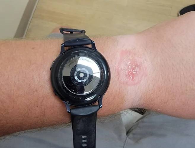 최근 영미권 최대 온라인 커뮤니티 레딧에는 갤럭시워치 액티브2를 착용한 채 잠을 자다가 손목에 화상을 입었다는 주장이 제기됐다. (사진=레딧 캡처) *재판매 및 DB 금지