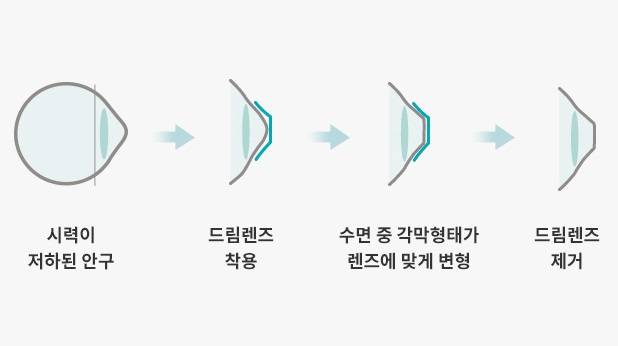 드림렌즈 원리ㅣ출처:비앤빛강남밝은세상안과