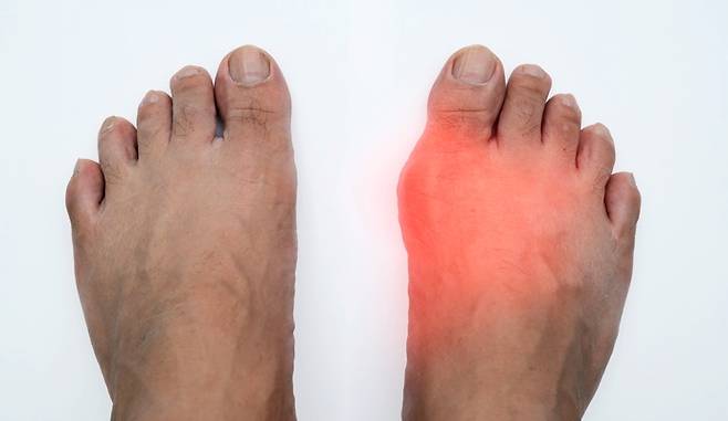 통풍으로 부어오른 발. 게티이미지뱅크