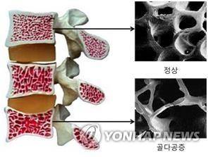 정상인과 골다공증 환자의 뼈 사진 [연합뉴스 자료사진]
