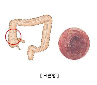 크론병 [출처: 서울아산병원]