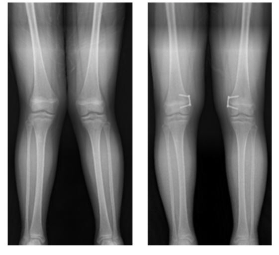 외반슬(엑스자 다리, 왼쪽)에 대해 8자 금속판 이용한 대퇴골 내측 반성장판 유합술 후 교정(오른쪽)된 모습.