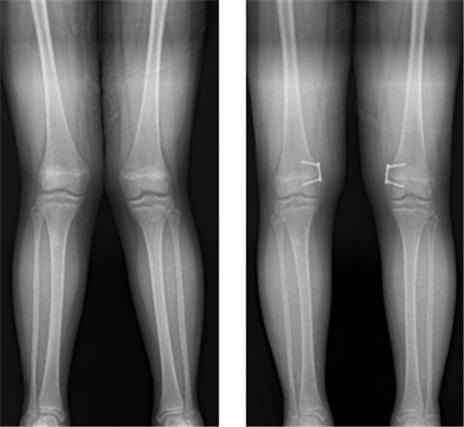 외반슬(엑스자 다리·왼쪽)에 대해 8자 금속판 이용한 대퇴골 내측 반성장판 유합술 후 교정된 환자.