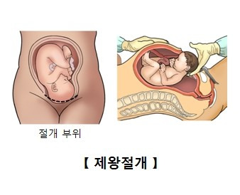 제왕절개 분만 [출처: 서울아산병원]