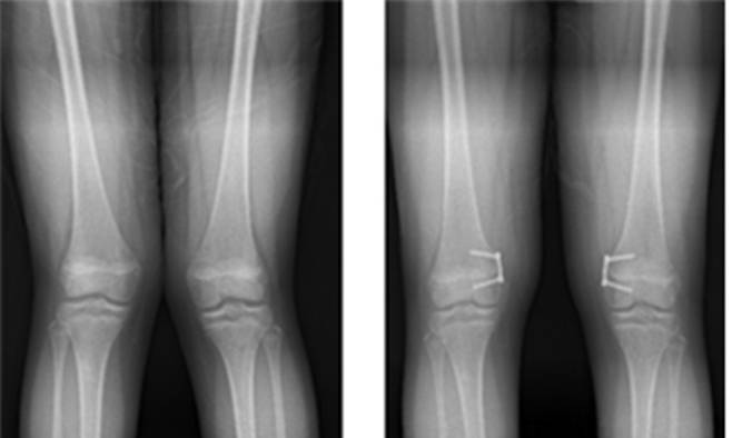 외반슬(엑스자 다리) 교정 전(왼쪽)과 8자 금속판 이용한 대퇴골 내측 반성장판 유합술 후 모습. 분당서울대병원 제공 