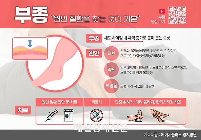 부종은 왜 생기고 어떻게 치료해야 하나