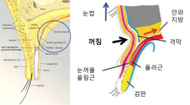 눈을 뜨려는 근육의 과도한 작용으로 지방이 함께 안으로 말려들어가면 눈꺼풀이 꺼진다.