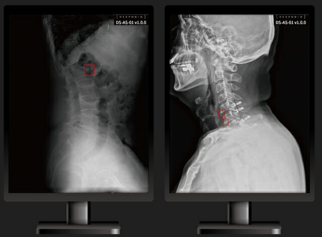 척추부위 의료영상 AI 솔루션 '딥스파인'(이미지=딥노이드)