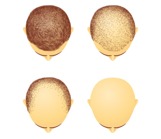 정수리 탈모와 앞머리 탈모ㅣ출처: 게티 이미지뱅크