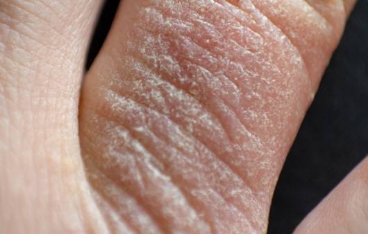 지루성피부염ㅣ출처: 게티 이미지뱅크