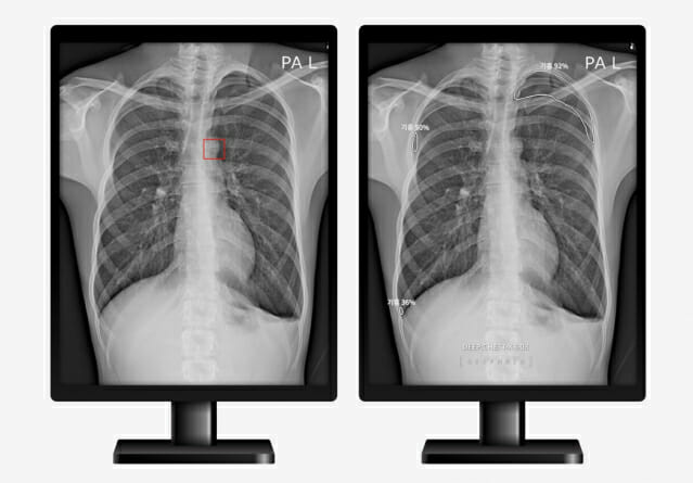 폐경화 질환에 대해 임상실험을 진행한 결과, 원본 왼쪽 이미지와 AI기반 의료기기를 통한 예측 결과가 적용된 오른쪽 이미지 비교. (이미지=딥노이드)