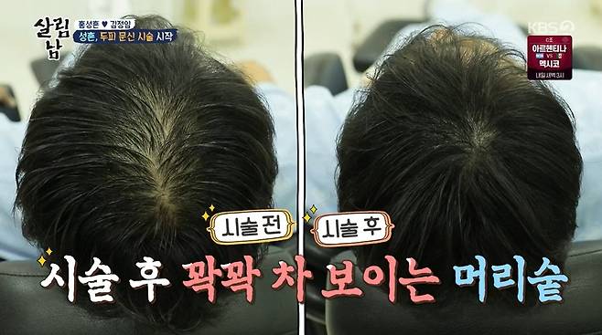 Hong Sung-heon underwent a scalp tattoo procedure.The story of Hong Sung-heon, who is worried about hair loss, was portrayed in Season 2 of KBS 2TV, which was broadcast on November 26th.Hong Sung-heon, who had severe hair loss stress, went to the hospital and consulted a doctor. The doctor said, It is progressing, but it is not enough to recommend hair transplantation.However, if left untreated, M-hair loss will be tee, he said. I recommend using scalp Tattoo while using hair loss medicine. Hong Sung-heon said, Ill do a scalp Tattoo right away, but as the people of Hair Loss know, every day is different. I decided to get the procedure because theres a lot of stress and theres no time to lose.