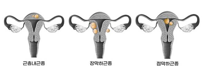 출처: 최상산부인과의원