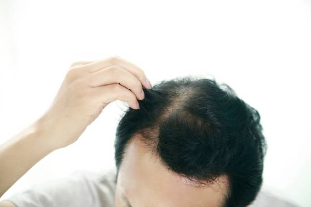 겨울철에는 대기가 건조해지면서 두피도 푸석해져 탈모 위험이 커지므로 두피 청결과 영양 공급에 신경 써야 한다./사진=클립아트코리아
