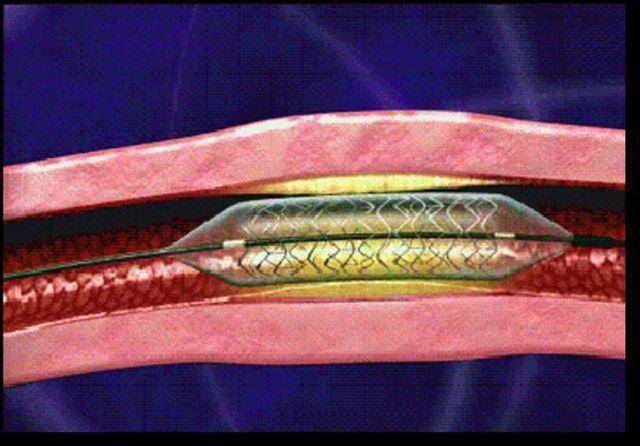 혈관 속에 스텐트가 삽입된 모습.