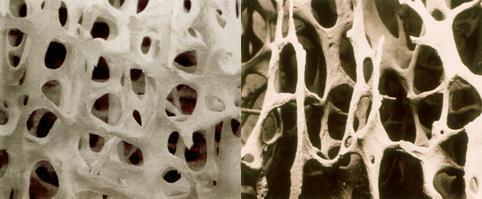 정상인의 뼈(왼쪽)와 골다공증 환자의 뼈