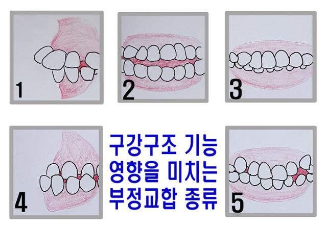 구강구조 기능에 영향을 미칠 수 있는 부정교합의 종류. 1. 상악전돌(측면에서 봤을 때 윗니와 윗턱이 돌출된 경우) 2. 개교(어금니는 맞닿지만 앞니 부분이 맞닿지 않고 벌어져 있는 경우) 3. 과개교합(윗니가 아랫니를 과하게 덮고 있을 경우) 4. 반대교합(측면에서 봤을 때 아랫니와 아래턱이 돌출돼 윗니를 덮을 경우) 5. 총생(치아가 좁은 부위에 뭉쳐서 나고 치아 배열이 부분적으로 넓을 경우). 김민규 기자