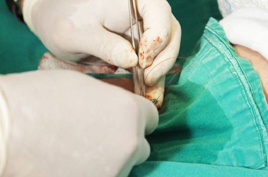 포경수술ㅣ출처: 게티이미지 뱅크