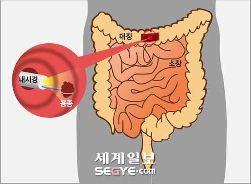 대장 용종 제거