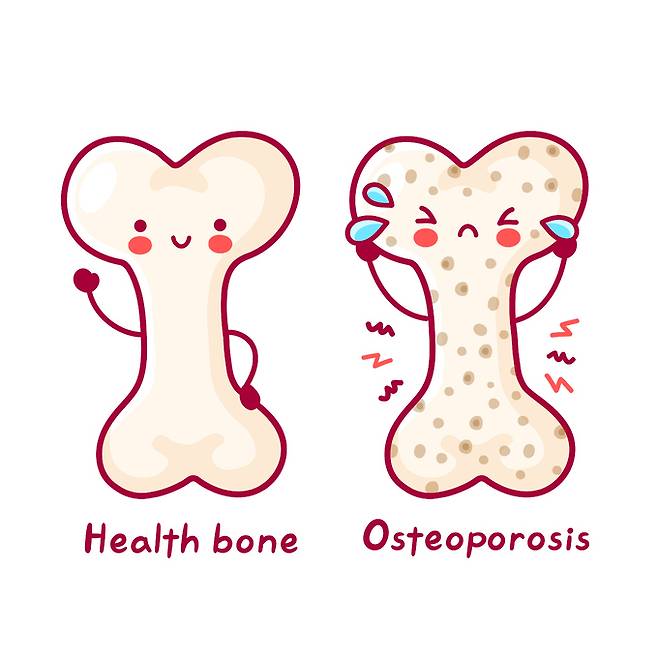 건강한 뼈(왼쪽)와 골다공증에 걸린 뼈. 게티이미지뱅크