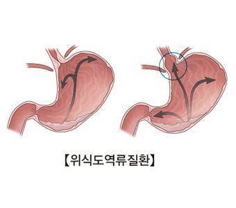 역류성 식도염 [출처: 서울아산병원]