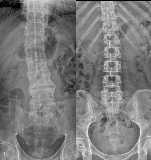 강직성 척추염(왼쪽)은 정상 척추(오른쪽)보다 관절 없이 하나의 긴 뼈처럼 이어진 모습이어서 ‘대나무 척추(bamboo spine)’라고도 불린다. 인천성모병원 제공