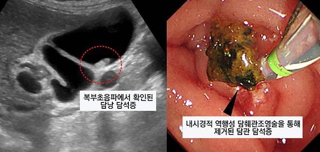 (왼쪽)복부초음파, (오른쪽)내시경적 역행성 담췌관조영술(ERCP)를 통해 확인된 담석증.