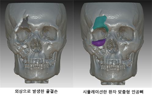 최근 3D 프린터로 맞춤형 이식을 받은 전모씨 사례 시뮬레이션 사진./사진=고려대 안암병원