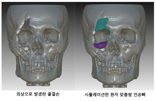 전씨의 함몰된 얼굴 뼈(왼쪽)와 3D프린팅으로 원래 모습에 가까이 복원한 얼굴 뼈(오른쪽). /사진=고려대 안암병원