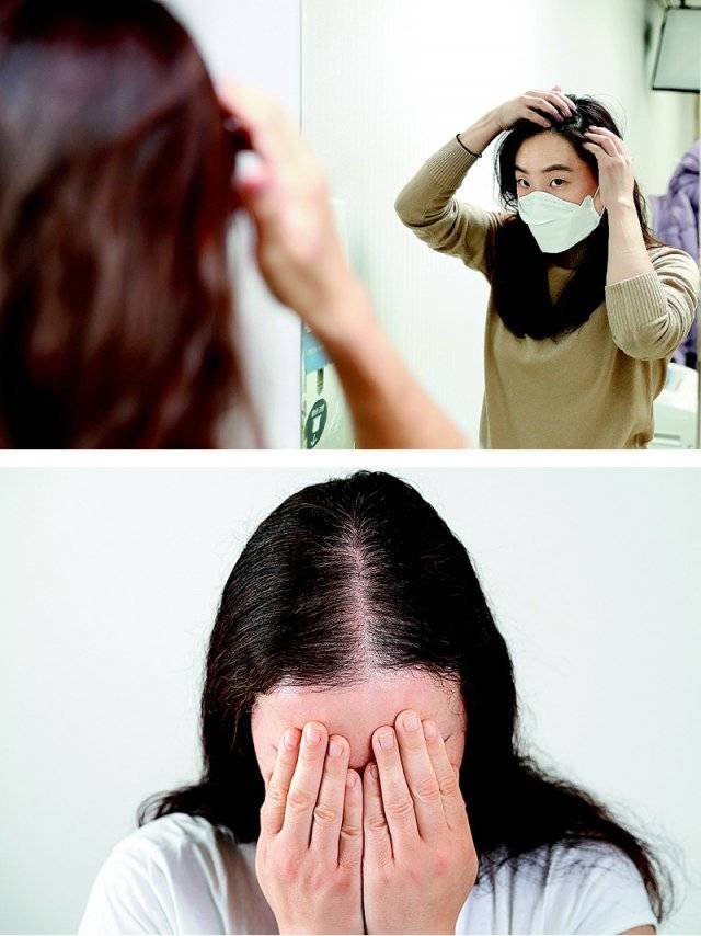 한 여성이 탈모 여부를 확인하기 위해 거울을 보고 있다(위쪽 사진). 여성형 탈모는 남성형 탈모와 다르게 모발 사이사이로 두피가 상대적으로 많이 보이는 크리스마스트리 형태로 잘 나타난다. 고려대구로병원·게티이미지코리아 제공