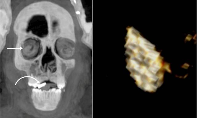 카이로 대학 연구팀이 촬영한 '황금 혀'. 고대 이집트인들은 사후 세계에서 대화하기 위해 황금 혀가 필요하다고 믿었다.  Frontiers in Medicine 홈페이지 캡처