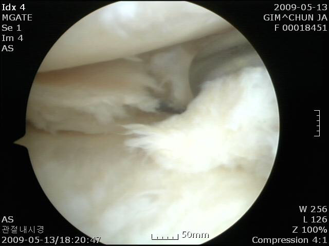 관절내시경으로 살펴본 내측 반월상연골판 파열의 모습.