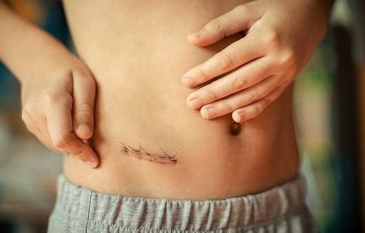 최근 충수염 수술은 개복 수술보단 복강경 수술 방법을 사용한다ㅣ출처: 게티이미지뱅크