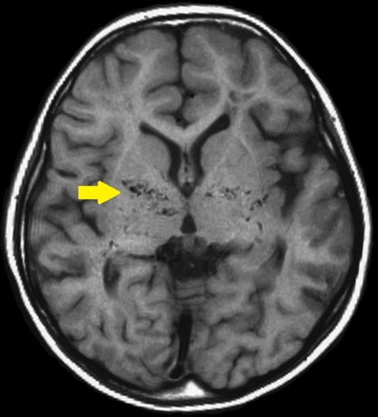 뇌 MRI 영상으로 확인된 모야모야병 환자의 발병 모습. 사진제공=Takuma-sa