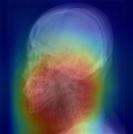 두경부 X-ray 영상을 활용한 수면무호흡증 진단 예시.딥러닝 알고리즘이 수면무호흡증 여부를 분류하는 이미지 상 특이점의 위치(붉은색)를 확인할 수 있다. 사진제공=서울대학교 의대 분당서울대병원