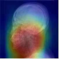 딥러닝 알고리즘이 수면무호흡증 여부를 분류하는 이미지 상 특이점의 위치(붉은색)를 확인할 수 있다. 분당서울대병원 제공