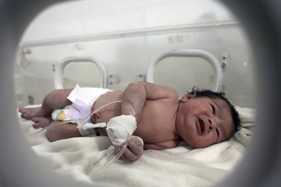 시리아의 지진 폐허 속에서 엄마와의 탯줄이 끊어지지도 않은 상태에서 구조된 아기. AP