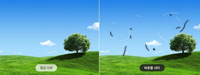 출처:비앤빛강남밝은세상안과