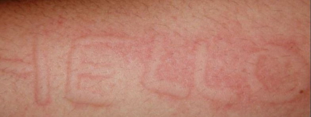 피부묘기증 질환은 건조한 겨울에 심해질 수 있는 피부질환이다./사진=DermNetNZ 소셜미디어 캡처