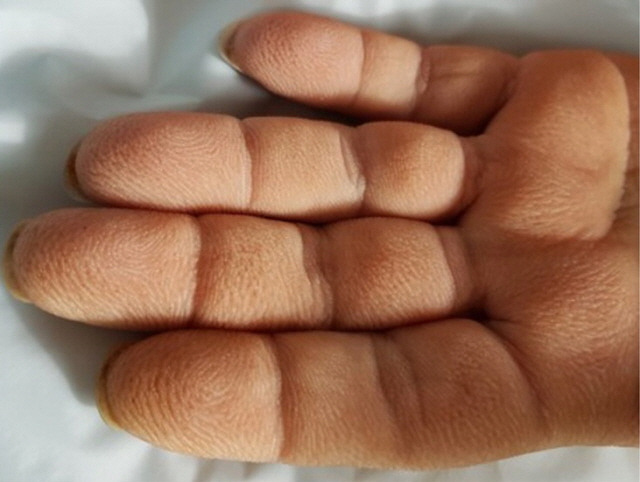 흑색가시세포증이 발생한 손바닥/사진=Acanthosis Palmaris: A Rare Paraneoplastic Manifestation of Non–Small-Cell Lung Cancer(2018 by American Society of Clinical Oncology)