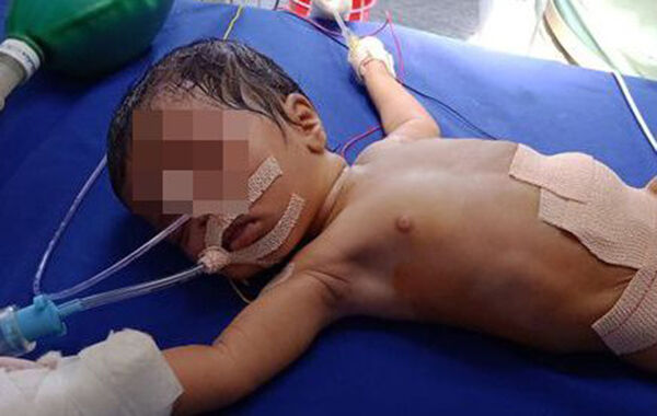 지난해 10월 인도에서 태어난 신생아 뱃속에서 기생 태아 8명이 발견됐다. 사진은 수술을 마친 여아의 모습. (사진=NDTV 캡쳐)