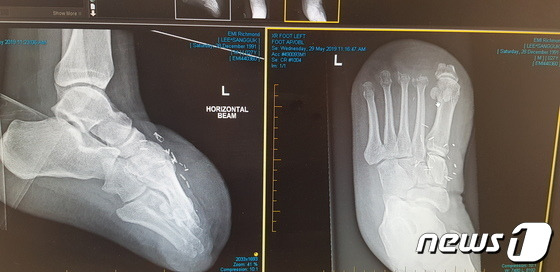 이상국씨 발가락 절단 엑스레이 사진(이상국씨 제공) ⓒ 뉴스1