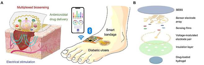 전자 반창고는 상처에 달라붙어 약물을 방출하고 전류를 흘려 상처를 치료한다. 센서가 감지한 상처 상태는 스마트폰이나 의료진의 컴퓨터로 전송돼 환자 맞춤형 치료가 가능하다(A). 전자 반창고는 잘 늘어나는 고분자 소재 밑에 센서 역할을 하는 얇은 전극이 있고, 그 밑에는 전류를 발생하는 원형 전극이 있다. 상처에 닿는 맨 아래층에 약물이 젤리 상태의 하이드로겔에 들어있다(B). /Science Advances