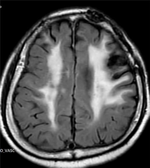 백질 변성이 오래되고 진행한 73세 환자의 뇌 MRI 사진. 뇌 중심부에 하얀색으로 넓게 퍼져 있음. 부천성모병원 제공