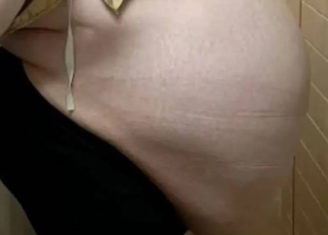 수술 전 촬영된 앨리슨 피셔(20)의 복부 사진/사진=뉴욕포스트