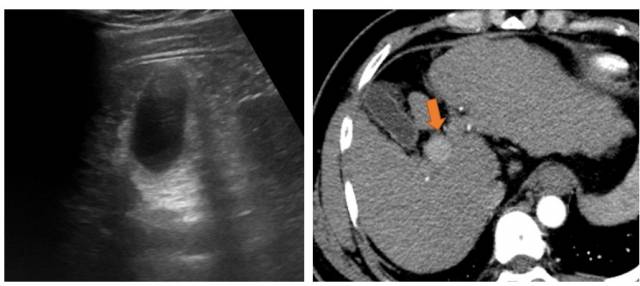 간경화증이 심한 환자는 간초음파(왼쪽)를 시행해도 담남 옆의 간세포암이 잘 보이지 않는다. 이 때 CT 검사를 시행하면 조영제 주사 후 주변보다 밝게 간세포암이 잘 보이는 것을 확인할 수 있다. 사진 제공=서울성모병원